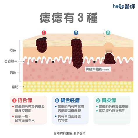 手臂長痣|痣形成的原因？痣長毛、痣變多變大是痣病變？5招判別